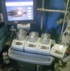 SARNS SYSTEM 1 Arrhythmia
