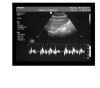 PHILIPS 3D8-4 Ultrasound Transducer