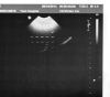 PHILIPS C8-5 Ultrasound Transducer