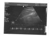 PHILIPS 3D6-2 Ultrasound Transducer