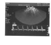 PHILIPS C8-4v Ultrasound Transducer