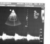 PHILIPS X7-2 Ultrasound Transducer