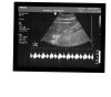 PHILIPS V6-2 Ultrasound Transducer