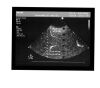 PHILIPS S5-2 Ultrasound Transducer