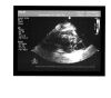 PHILIPS S5-2 Ultrasound Transducer