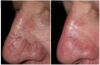 IRIDEX DioLite Laser - KTP