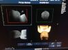 PHILIPS V6-2 Ultrasound Transducer