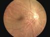MIIS 5 mpx AutoFocus Portable Fundus Camera