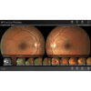 DEC Fundus Digital Upgrade Fundus Camera