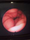 ACMI ACN-2 Cystoscope