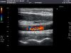 TOSHIBA PLT-604AT Ultrasound Transducer