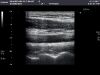 TOSHIBA PLT-604AT Ultrasound Transducer