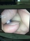 OLYMPUS A50002A Laparoscope