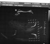 PHILIPS C5-1 Ultrasound Transducer