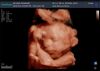 SONOSCAPE P15 Trolley Color Doppler System Ultrasound - OB / GYN