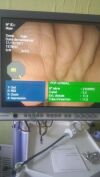 OLYMPUS PCF-Q180AL Colonoscope