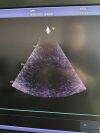 GE Vivid E95 Ultrasound - Cardiac - Vascular