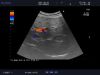 ALOKA UST-9115-5 Ultrasound Transducer