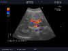 ALOKA UST-9130 Ultrasound Transducer