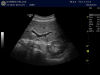 GE C1-5-D Ultrasound Transducer