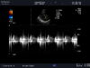 ALOKA UST-5299 Ultrasound Transducer