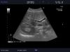 ALOKA UST-9123 Ultrasound Transducer