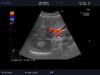 ALOKA UST-9123 Ultrasound Transducer