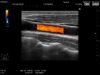 HITACHI EUP-L75 Ultrasound Transducer