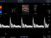 ALOKA UST-5415 Ultrasound Transducer