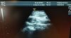 GE S4-10-D Ultrasound Transducer