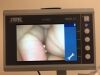 KARL STORZ 11302BDX  with 8403ZX Monitor Intubation Scope