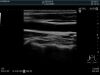 HITACHI L34 Ultrasound Transducer