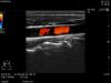 HITACHI L64 Ultrasound Transducer