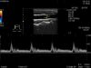 HITACHI L64 Ultrasound Transducer