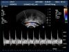 PHILIPS C8-4v Ultrasound Transducer