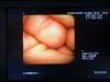 PENTAX VB-2000 Bronchoscope