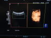 HITACHI Arietta 70 Ultrasound - OB / GYN