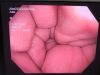 OLYMPUS CF-H180AL Colonoscope
