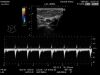 HITACHI L44 Ultrasound Transducer