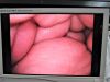 OLYMPUS LTF-VP Laparoscope