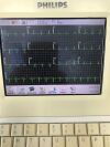 PHILIPS Pagewriter III EKG