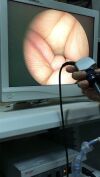 STRYKER model 882TE with light source Q 4000 Endoscopy Processor