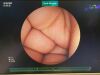 FUJINON EN-450P5/20 Enteroscope