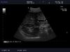 ALOKA ASU-1010 Ultrasound Transducer