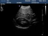 PHILIPS C9-4 Ultrasound Transducer