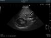 HITACHI C22K Ultrasound Transducer