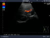 ALOKA UST-990-5 Ultrasound Transducer