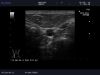 ALOKA UST-5524 Ultrasound Transducer