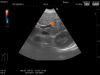 HITACHI EUP-B512 Ultrasound Transducer