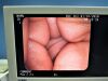 PENTAX VNL-1570STK Laryngoscope